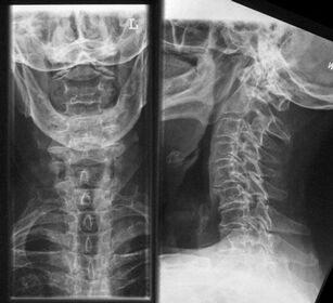 Radiografia coloanei cervicale - o metodă pentru diagnosticarea osteocondrozei