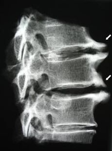 Osteofitele coloanei cervicale provoacă dureri de gât