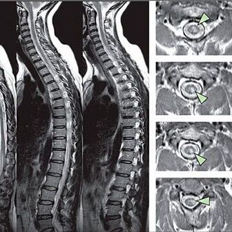 diagnosticul osteocondrozei toracice